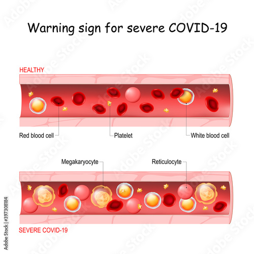 COVID-19. Warning sign for severe acute respiratory syndrome coronavirus disease photo