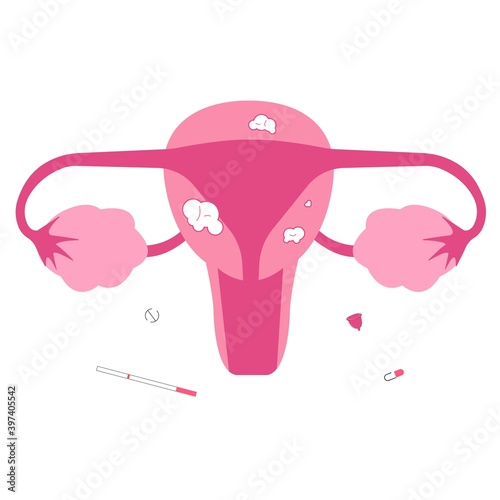 Uterine fibroid. Female reproduction organ problems. Infertility causes.