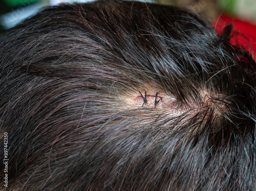 head injury treated by suture.