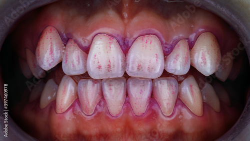 plaque indicator on teeth before professional cleaning by a dental hygienist