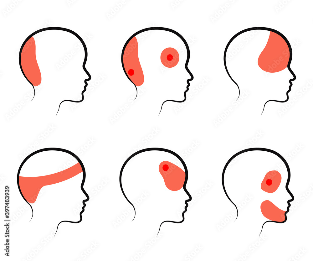 Vecteur Stock Types of headaches on a white background. Silhouette ...