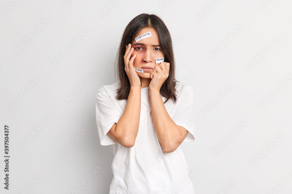 Unhappy stressed Asian woman has difficult fate poses with big awful bruise under eye becomes victim of trafficking violence and aggression being hit by lover poses indoor against white background Unhappy stressed Asian woman has difficult fate poses with big awful bruise under eye becomes victim of trafficking violence and aggression being hit by lover poses indoor against white background