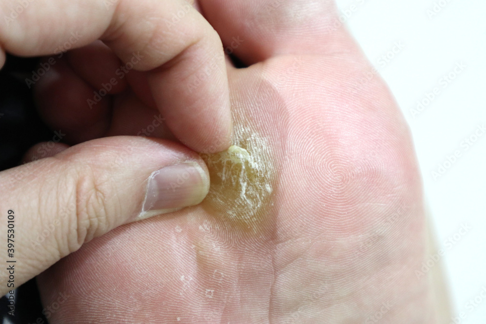 callus callus