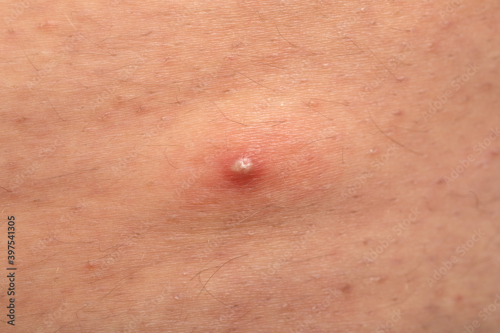 Fototapeta premium Hormonal disorder - acne on skin
