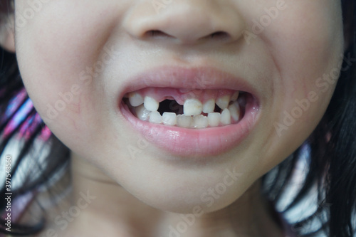 close up little girl show broken tooth.