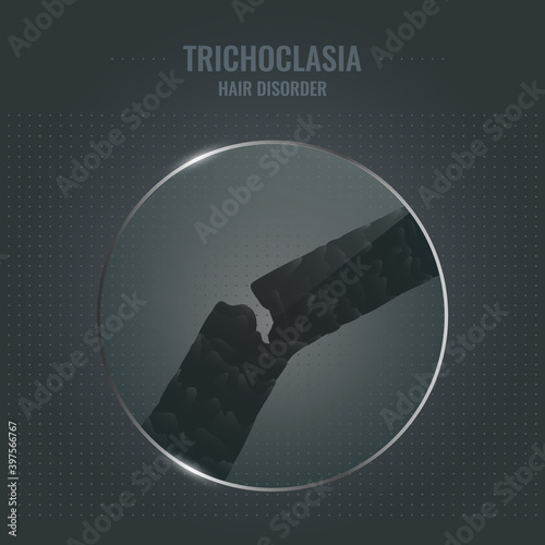 Trichoclasia damaged hair surface under microscope. Hair follicle brittle condition closeup trichoscopy vector. Problem of fragility and breakage. Trichology medical concept.