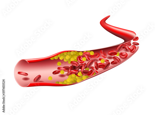 In the vein, cholesterol stops the flow of red blood cells. Vector illustration