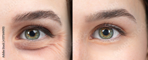 Woman eyes before and after an anti age treatment for wrinkles and crow's feet photo