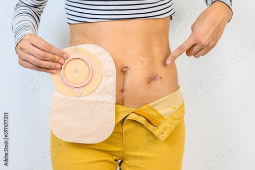 Woman holding colostomy bag in right hand and with left hand showing scar after surgery.
