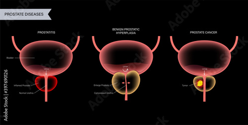 Prostate cancer concept