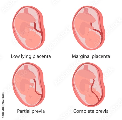 Four types of placenta previa concept illustration