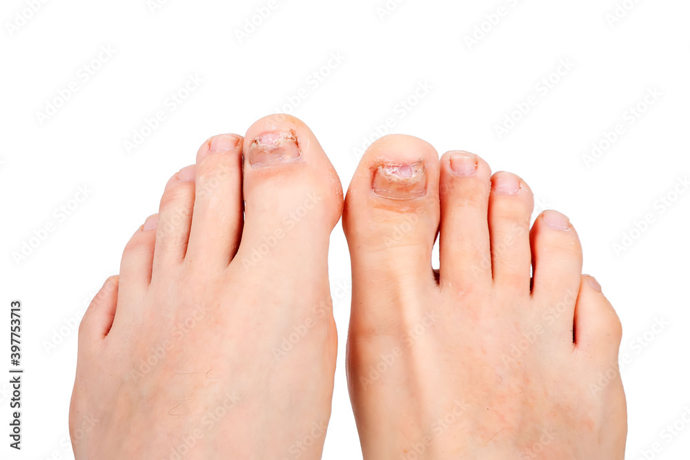 toenails affected by fungus, isolate, white background toenails affected by fungus, isolate, white background
