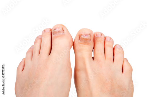 toenails affected by fungus, isolate, white background