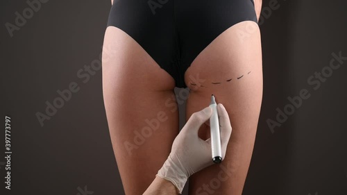 plastic surgeon marking womans body for surgery. High quality video