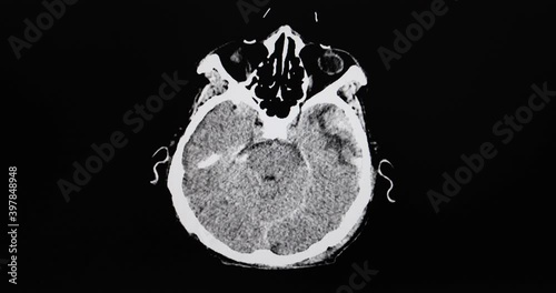 A CT cine scan of a traumatized patient showing intracerebral hemorrhage subdural and subarachnoid hemorrhage.  photo