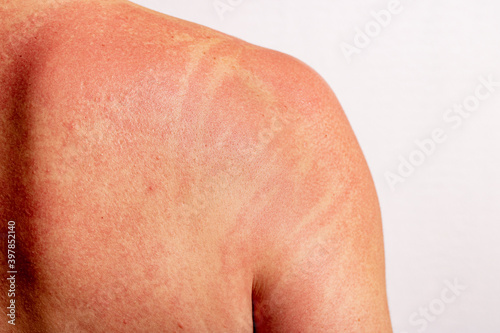 Back and shoulder skin Allergy. Allergic reactions on the skin in the form of redness.