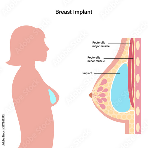 Breast Implant Concept