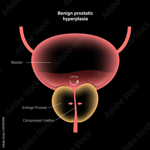 BPH info concept