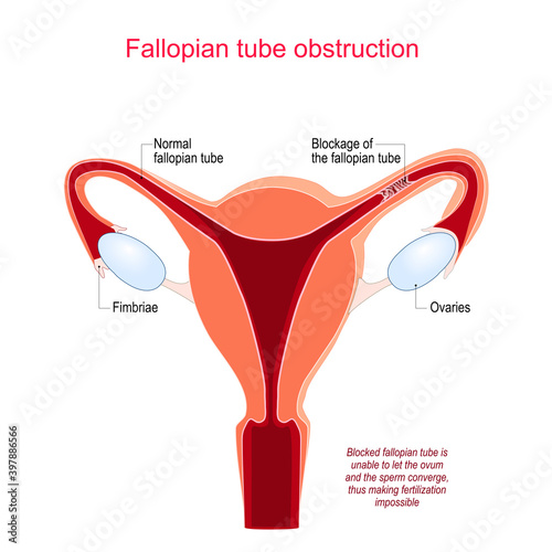 Fallopian tube obstruction. Human uterus with normal and Blocked Fallopian Tubes.