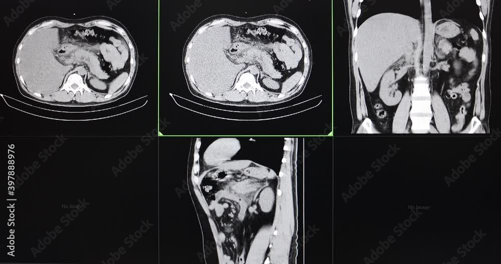 CT cine scan of an abdomen of a patient with acute pancreatitis, small gallstone and fatty liver.