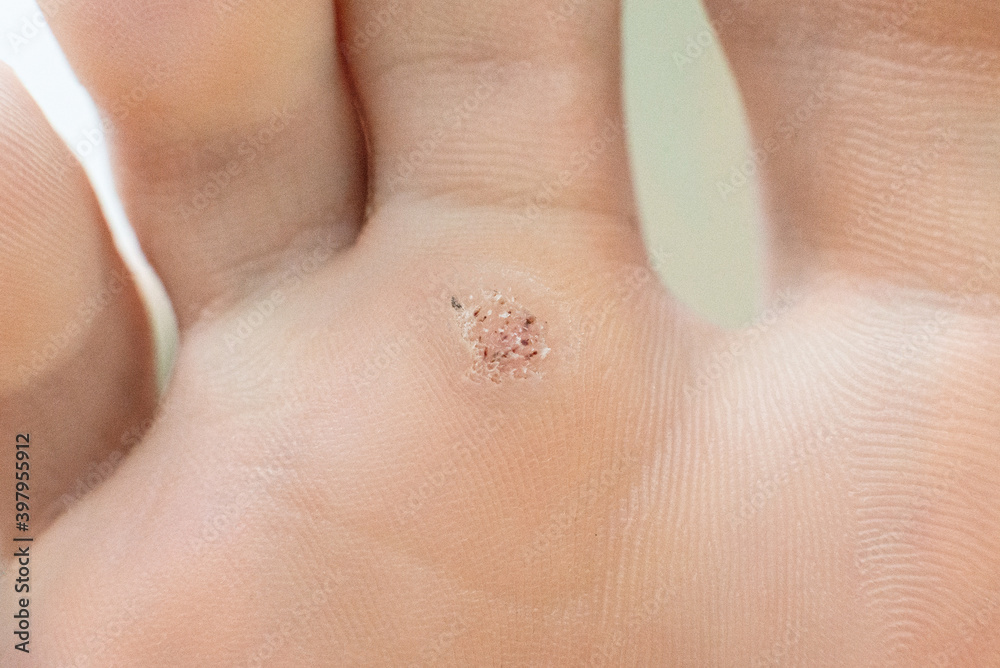 wart on a blunt close-up. Macro shot of human papilloma on the foot. wart on a blunt close-up. Macro shot of human papilloma on the foot.