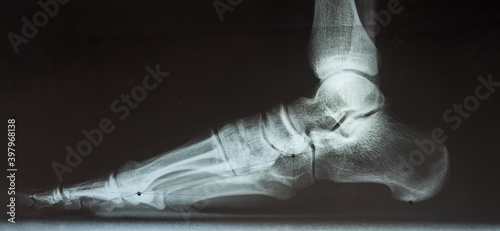 X-ray of the male foot to determine flat feet