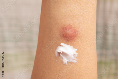 Quadro em tela Applying topical antihistamine medicine cream on little boy body with insect bit