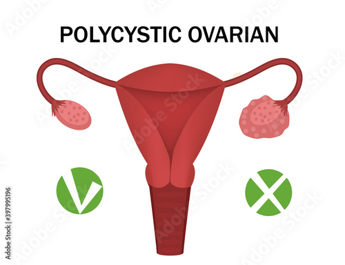 Polycystic ovary disease and a healthy ovary. medical infographics. Vector illustration photo