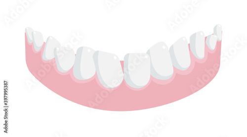 Human lower jaw gum with crooked teeth isolated on white
