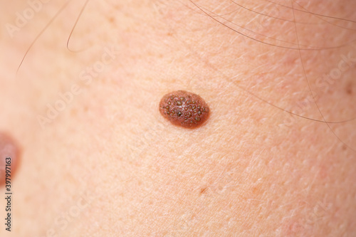 Close up shot of human skin and mole photo