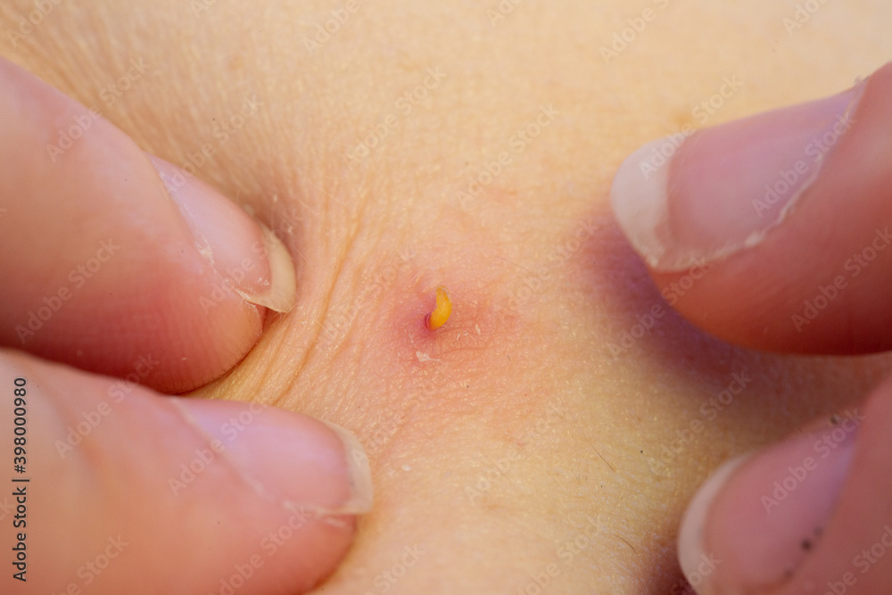 Fototapeta premium Close up picture of girl presses hands with purulent acne
