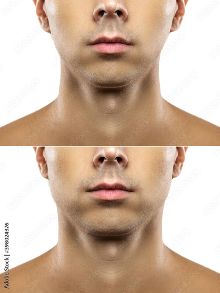 Surgery or mewing exercises. Result of a jawline reshape. Stock