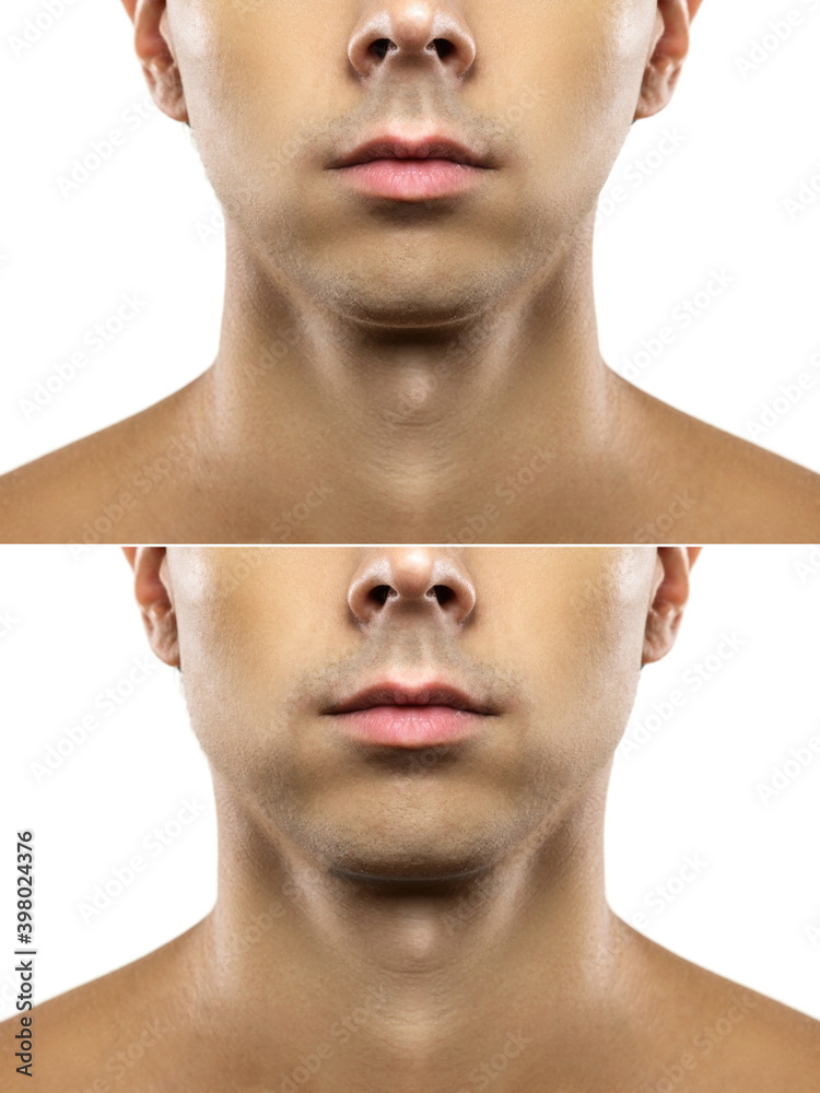 Mewing Exercises. Result of a Jawline Reshape Stock Photo - Image of  reshape, plastic: 245717018