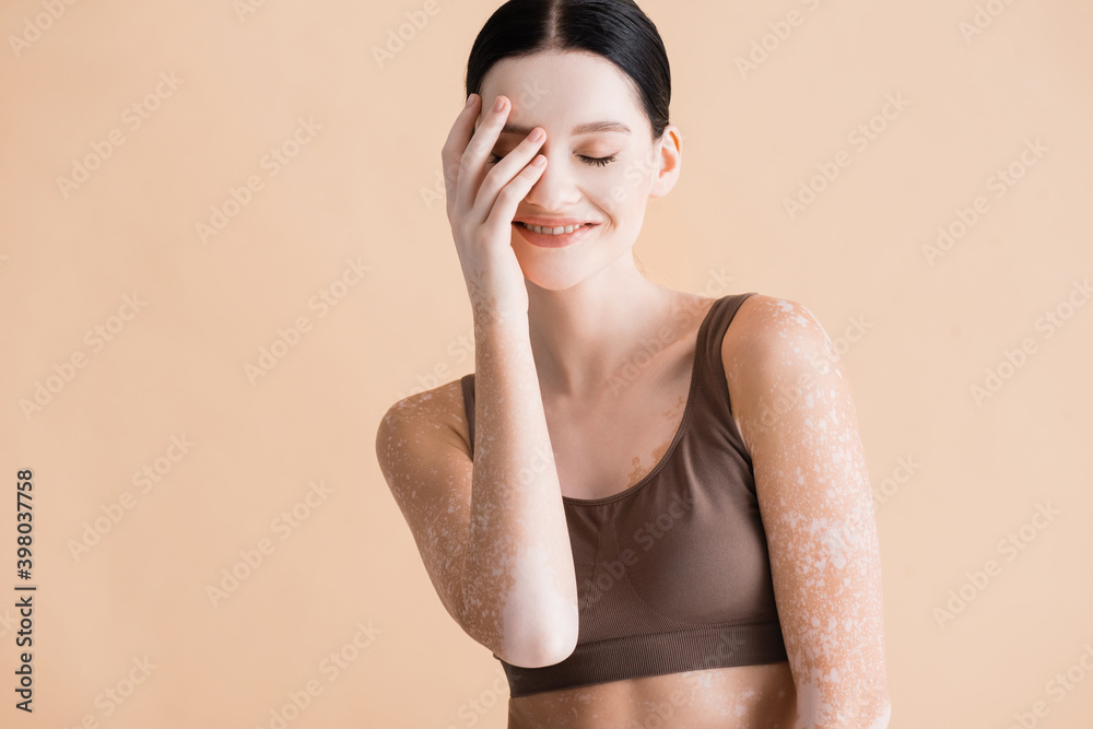 Fototapeta premium smiling young beautiful woman with vitiligo posing in underwear isolated on beige