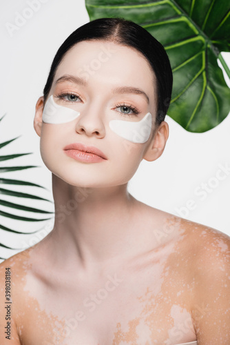 young beautiful woman with vitiligo and eye patches on face isolated on white