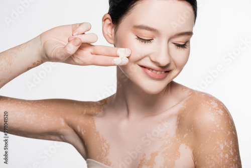 smiling young beautiful woman with vitiligo applying cosmetic cream isolated on white photo