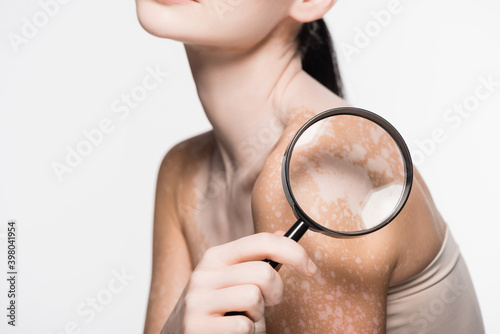 cropped view of young beautiful woman with vitiligo holding magnifying glass isolated on white photo