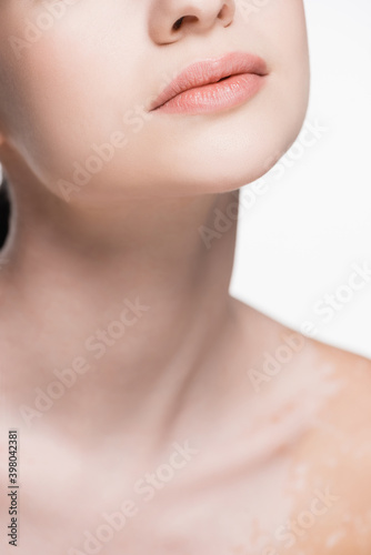 cropped view of young beautiful woman with vitiligo isolated on white