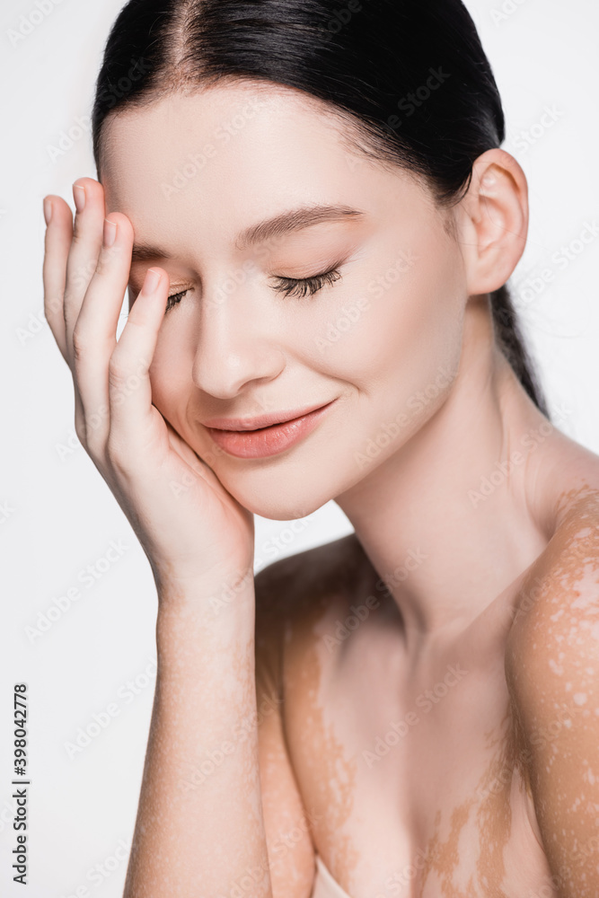 smiling young beautiful woman with vitiligo isolated on white smiling young beautiful woman with vitiligo isolated on white