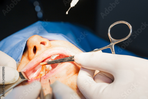 Close-up Buccal fat removal. Bisha lumps removal. Plastic surgery in clinic. Plastic surgery operation for modifying face in medical clinic. photo