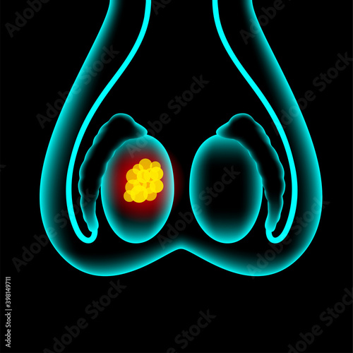 Prostate cancer concept