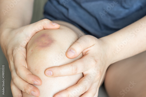 Bruise on the knee of a young white woman