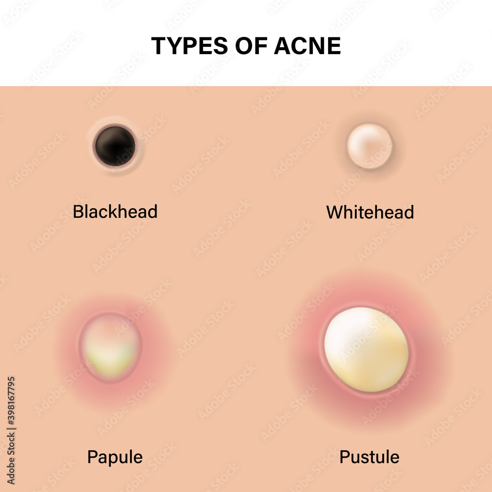 Type of acne diagram, Skin acne on top view, Blackhead, Whitehead ...