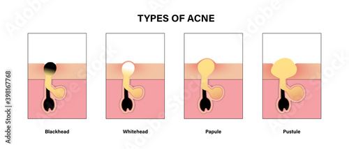 Type of acne diagram, Blackhead, Whitehead, Papule, Pustule, Skin problems