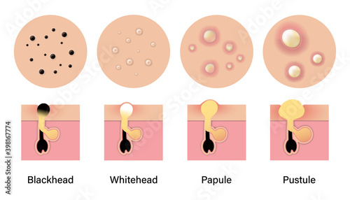 Type of acne diagram, Blackhead, Whitehead, Papule, Pustule, Skin problems