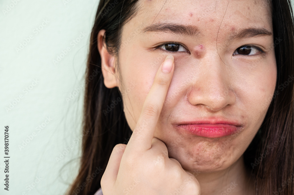 Worried Asian woman pointing hard pimple (or Elephant head acne) with acne inflamed on her face. Worried Asian woman pointing hard pimple (or Elephant head acne) with acne inflamed on her face.