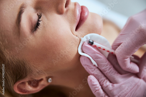 Female doctor reducing the appearance of the nasolabial folds