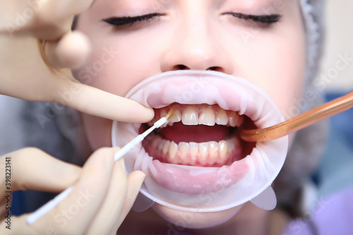 Professional teeth cleaning. The doctor applies a protective gel to the teeth. Caries prevention. A young girl at the dentist s appointment. Retractor in the mouth.