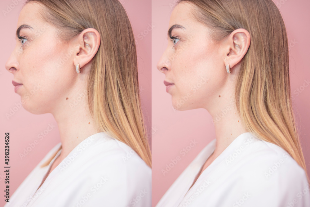 The result of cosmetic procedures before and after. Cosmetology, salon, personal care.
The result of cosmetic procedures before and after. Cosmetology, salon, personal care.