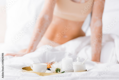 breakfast on tray near woman with vitiligo on blurred background